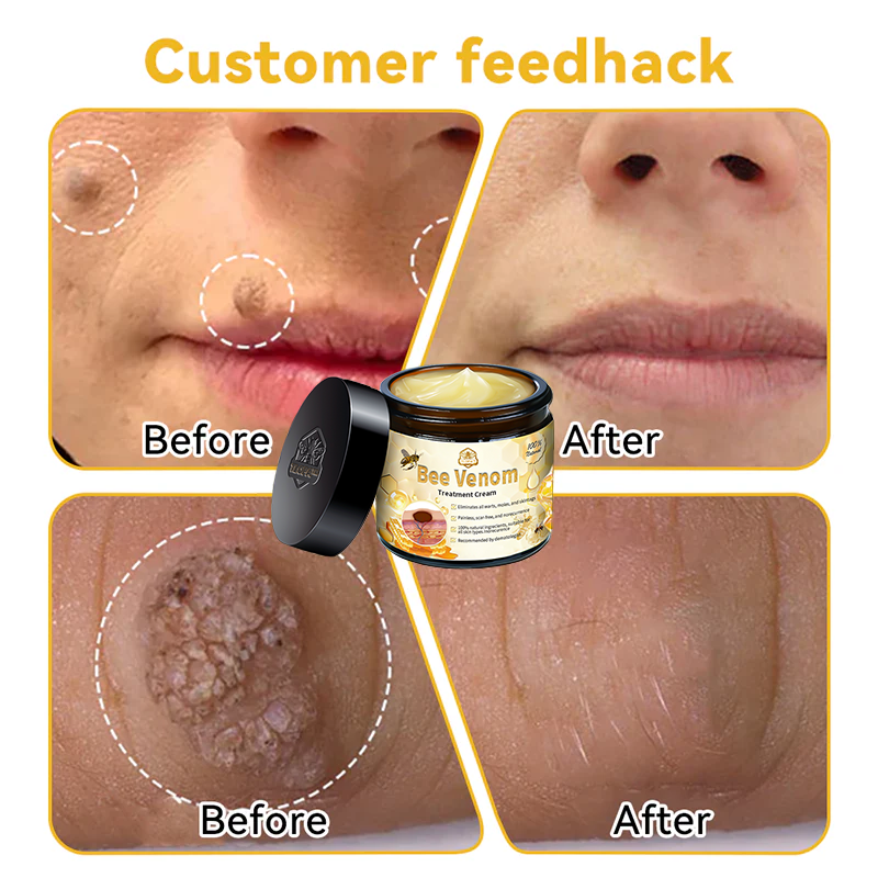 TLOPA® Bee Venom Skin Treatment Cream🌟(𝐵𝐴𝐷 𝑅𝑒𝑐𝑜𝑚𝑚𝑒𝑛𝑑𝑒𝑑)(🔥𝑳𝒂𝒔𝒕 𝒅𝒂𝒚 𝒑𝒓𝒐𝒎𝒐𝒕𝒊𝒐𝒏 70% 𝒐𝒇𝒇)
