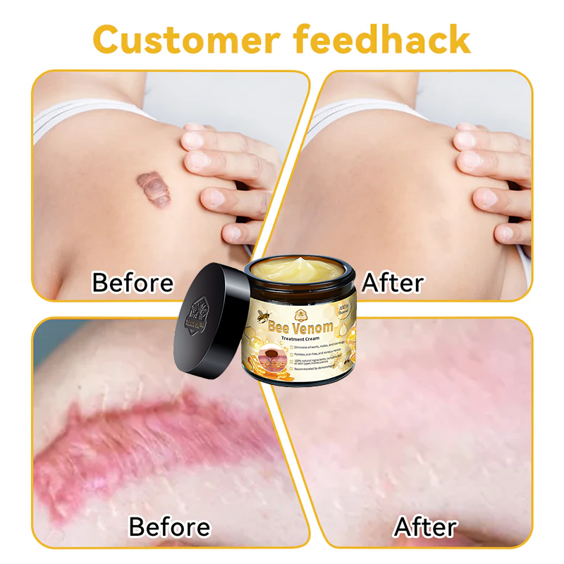 TLOPA® Bee Venom Skin Treatment Cream🌟(𝐵𝐴𝐷 𝑅𝑒𝑐𝑜𝑚𝑚𝑒𝑛𝑑𝑒𝑑)(🔥𝑳𝒂𝒔𝒕 𝒅𝒂𝒚 𝒑𝒓𝒐𝒎𝒐𝒕𝒊𝒐𝒏 70% 𝒐𝒇𝒇)