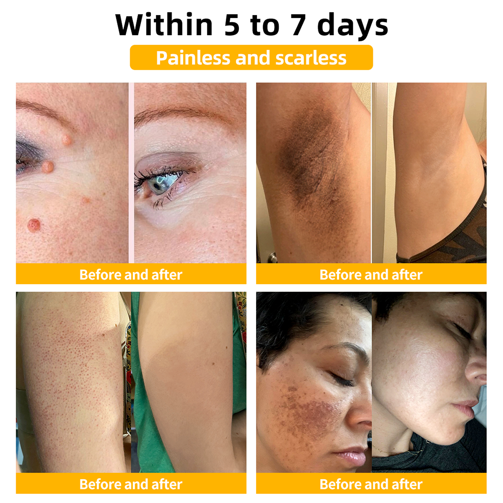 TLOPA® Bee Venom Skin Treatment Cream🌟(𝐵𝐴𝐷 𝑅𝑒𝑐𝑜𝑚𝑚𝑒𝑛𝑑𝑒𝑑)(🔥𝑳𝒂𝒔𝒕 𝒅𝒂𝒚 𝒑𝒓𝒐𝒎𝒐𝒕𝒊𝒐𝒏 70% 𝒐𝒇𝒇)